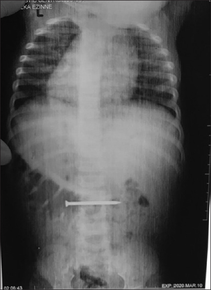 Foreign body in the gastrointestinal tract in children: A tertiary hospital experience.