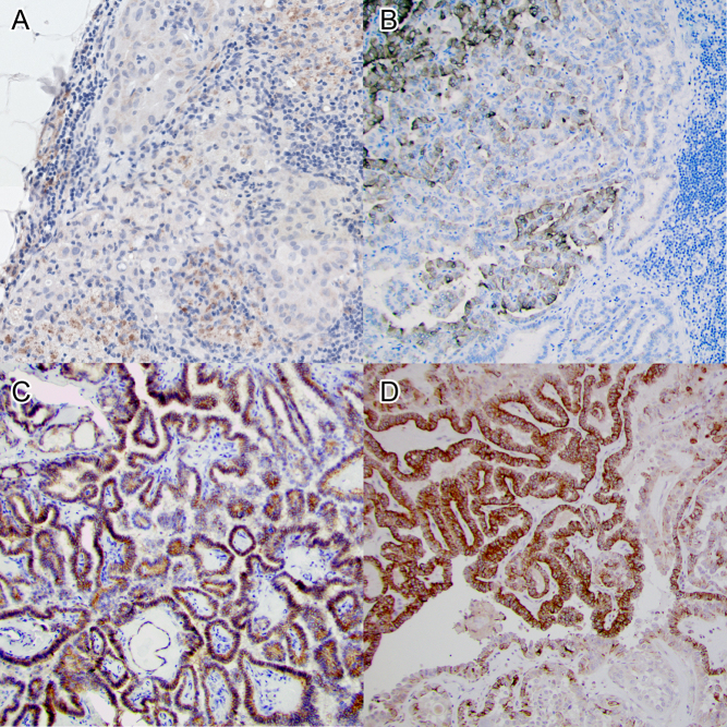 Iodine avidity in papillary and poorly differentiated thyroid cancer is predicted by immunohistochemical and molecular work-up.