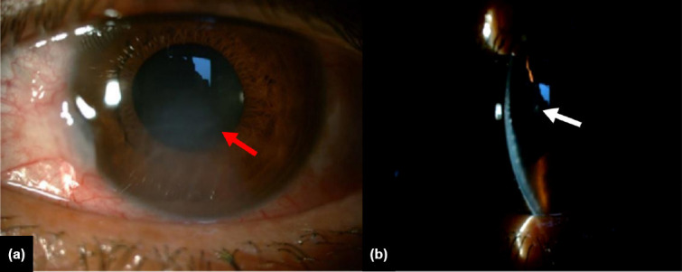 Intraocular foreign body in the anterior chamber angle misdiagnosed as herpetic stromal keratitis.