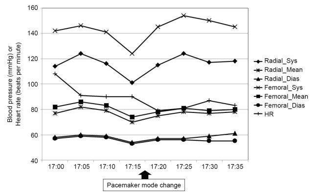 Sudden mode change of permanent pacemaker during living donor liver transplantation - A case report.