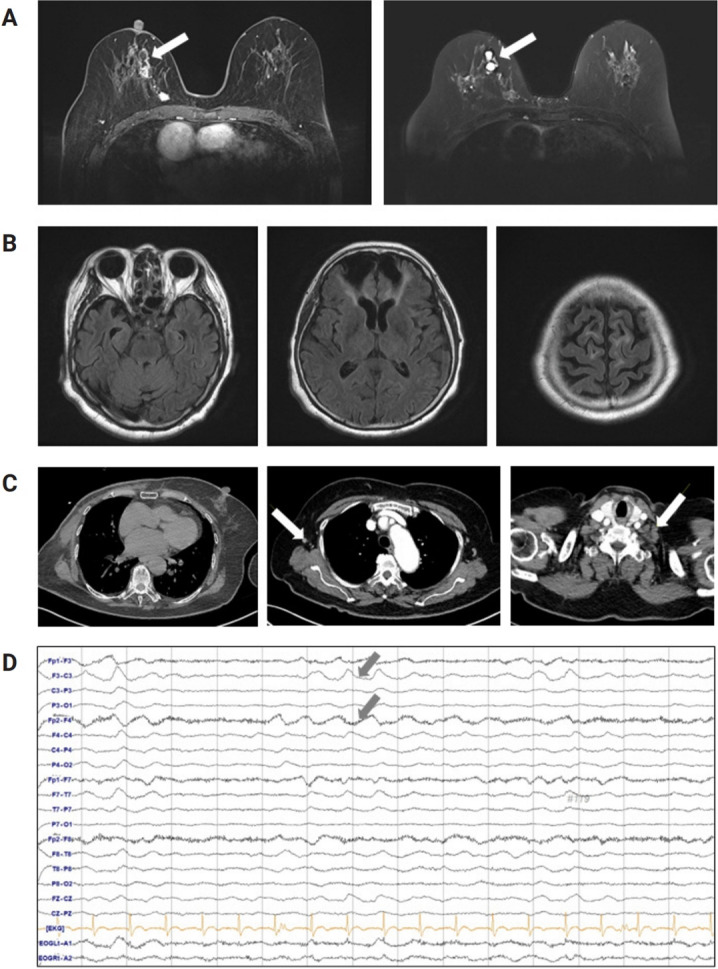 Atypical occurrence of anti-Ma2-associated encephalitis after breast cancer surgery and COVID-19.