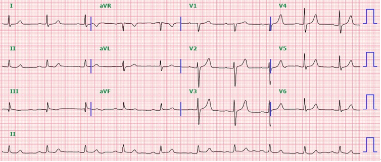 Sudden mode change of permanent pacemaker during living donor liver transplantation - A case report.