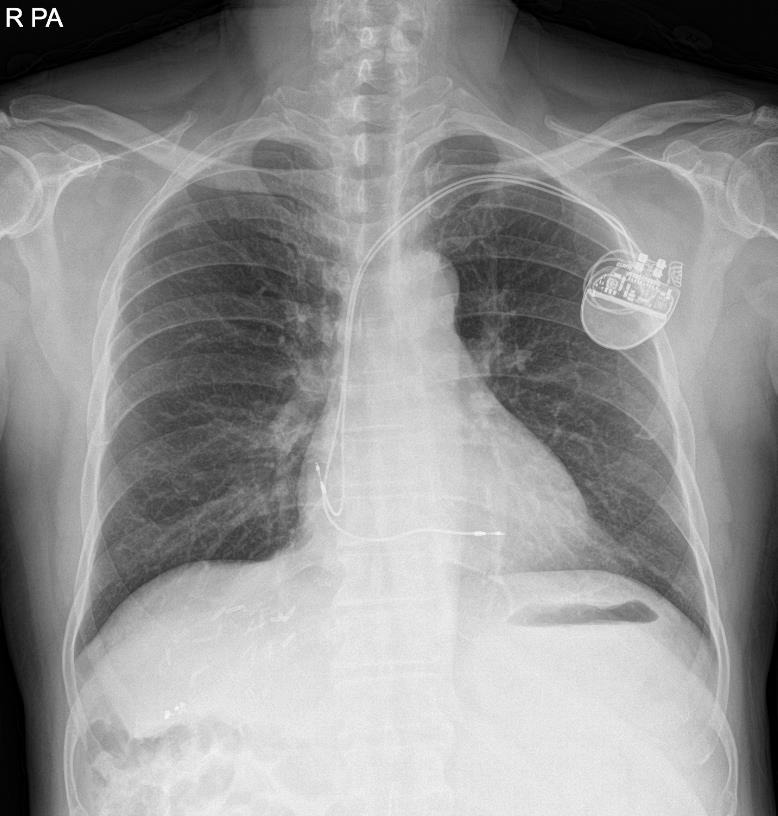 Sudden mode change of permanent pacemaker during living donor liver transplantation - A case report.