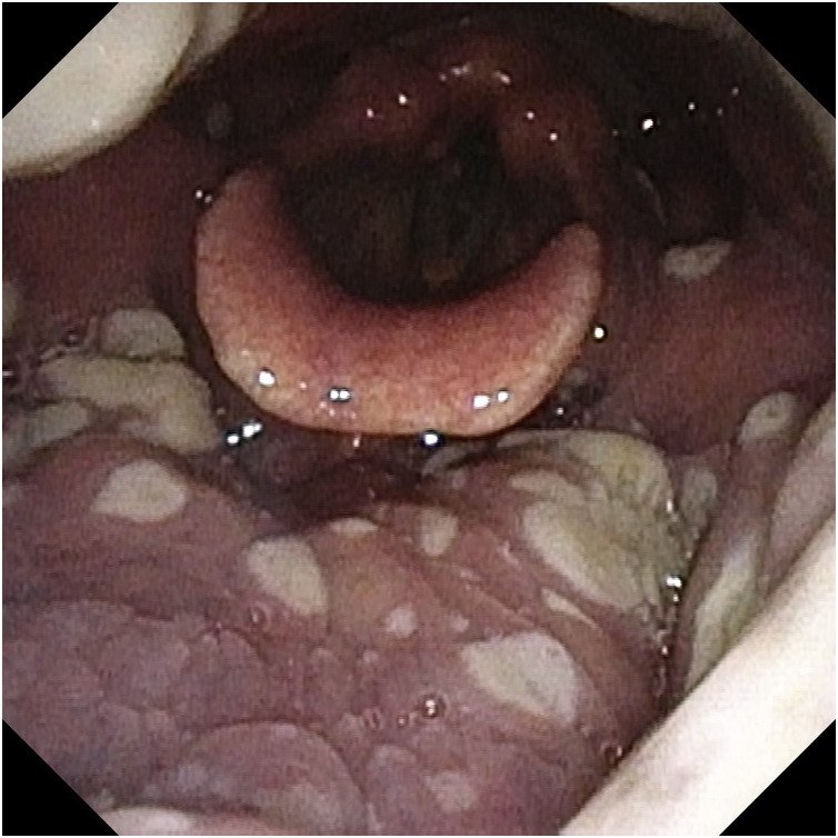 Oropharyngeal and laryngeal manifestations of human monkeypox