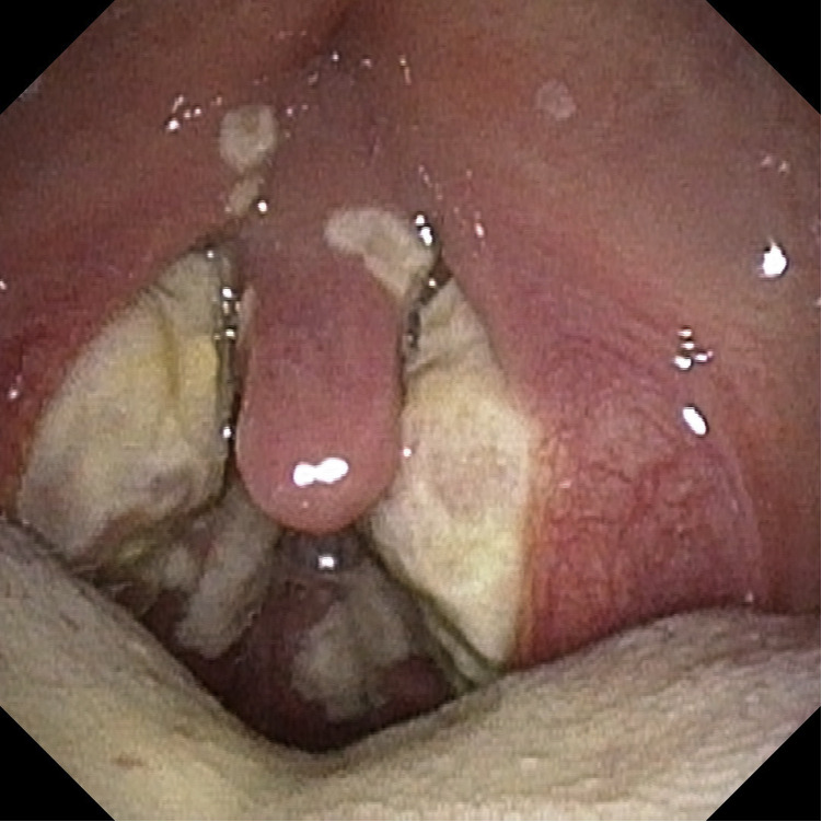 Oropharyngeal and laryngeal manifestations of human monkeypox