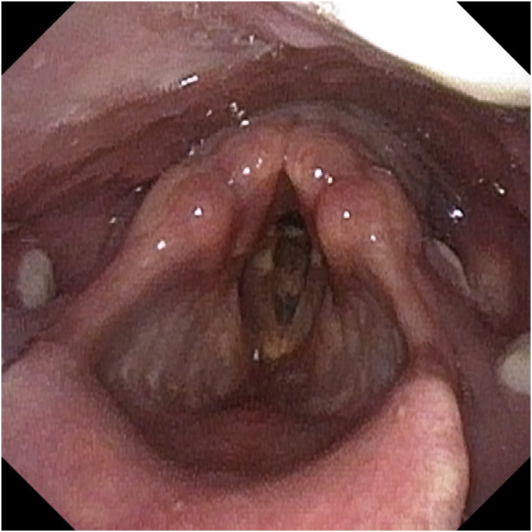 Oropharyngeal and laryngeal manifestations of human monkeypox