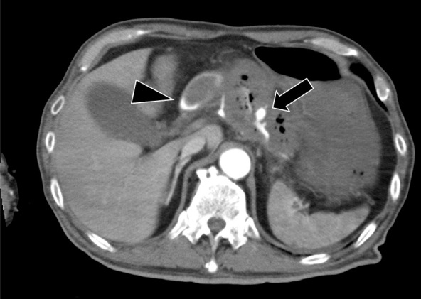 Gastrointestinal Bleeding Due to the Rupture of Splenic Artery Caused by Pancreatic Carcinoma: A Case Requiring Repeated Transcatheter Arterial Embolization in a Short Period of Time.