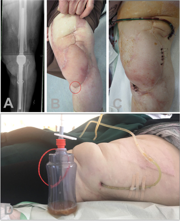 Enough is enough: salvage procedures in severe periprosthetic joint infection.