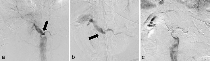 Gastrointestinal Bleeding Due to the Rupture of Splenic Artery Caused by Pancreatic Carcinoma: A Case Requiring Repeated Transcatheter Arterial Embolization in a Short Period of Time.