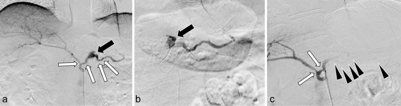 Gastrointestinal Bleeding Due to the Rupture of Splenic Artery Caused by Pancreatic Carcinoma: A Case Requiring Repeated Transcatheter Arterial Embolization in a Short Period of Time.