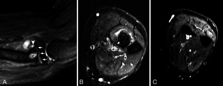 Posterior interosseous nerve paralysis secondary to an extraneural ganglion cyst from a radial neck pseudarthrosis: illustrative case.