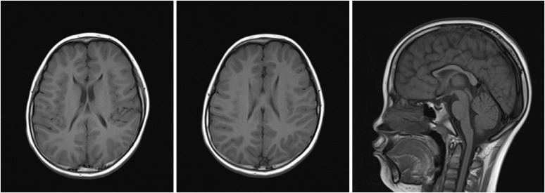 Syringomyelia: A New Phenotype of <i>SPG11</i>-Related Hereditary Spastic Paraplegia?