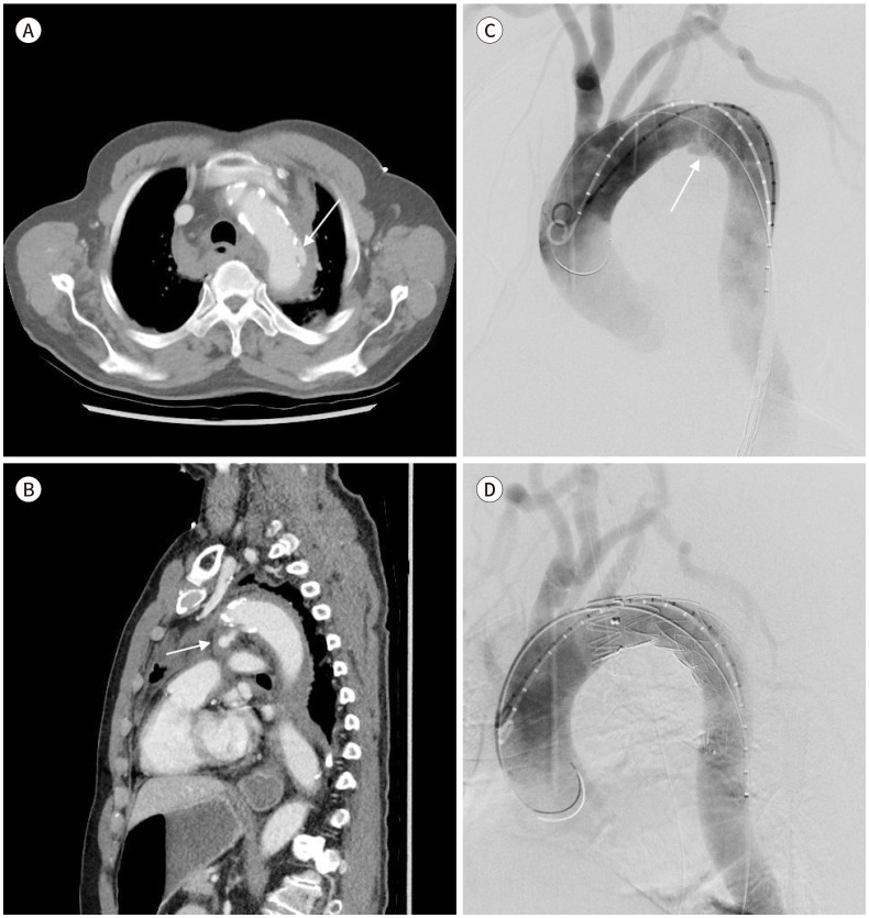 [Intervention for Chest Trauma and Large Vessel Injury].