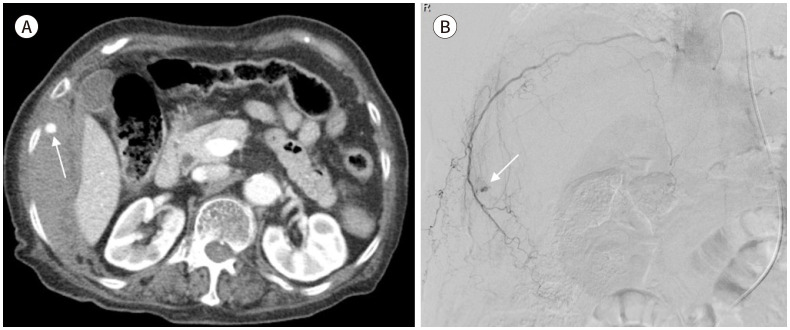 [Intervention for Chest Trauma and Large Vessel Injury].