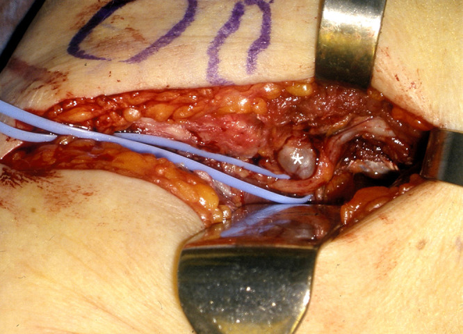 Posterior interosseous nerve paralysis secondary to an extraneural ganglion cyst from a radial neck pseudarthrosis: illustrative case.