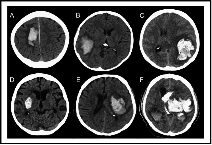 Hematoma expansion in intracerebral hemorrhage - the right target?