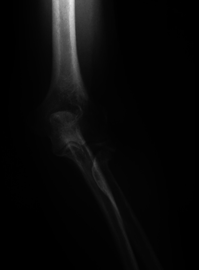 Posterior interosseous nerve paralysis secondary to an extraneural ganglion cyst from a radial neck pseudarthrosis: illustrative case.