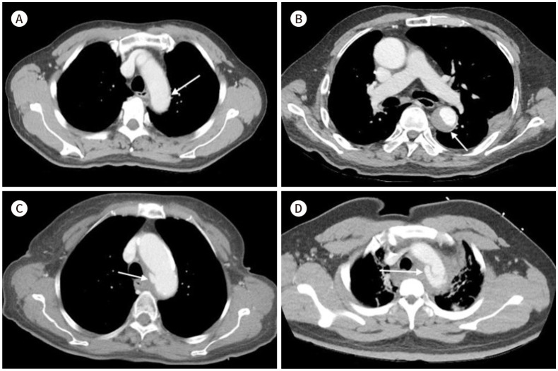 [Intervention for Chest Trauma and Large Vessel Injury].