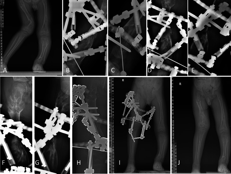 New bone formation accelerates during lower limb lengthening and deformity correction in children with Ollier's disease.