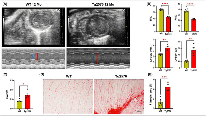 Amyloid β instigates cardiac neurotrophic signaling impairment, driving Alzheimer's associated heart disease.