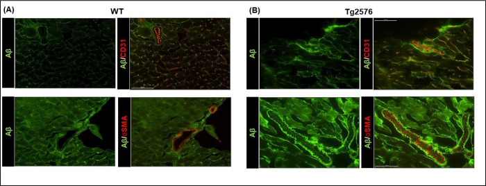 Amyloid β instigates cardiac neurotrophic signaling impairment, driving Alzheimer's associated heart disease.