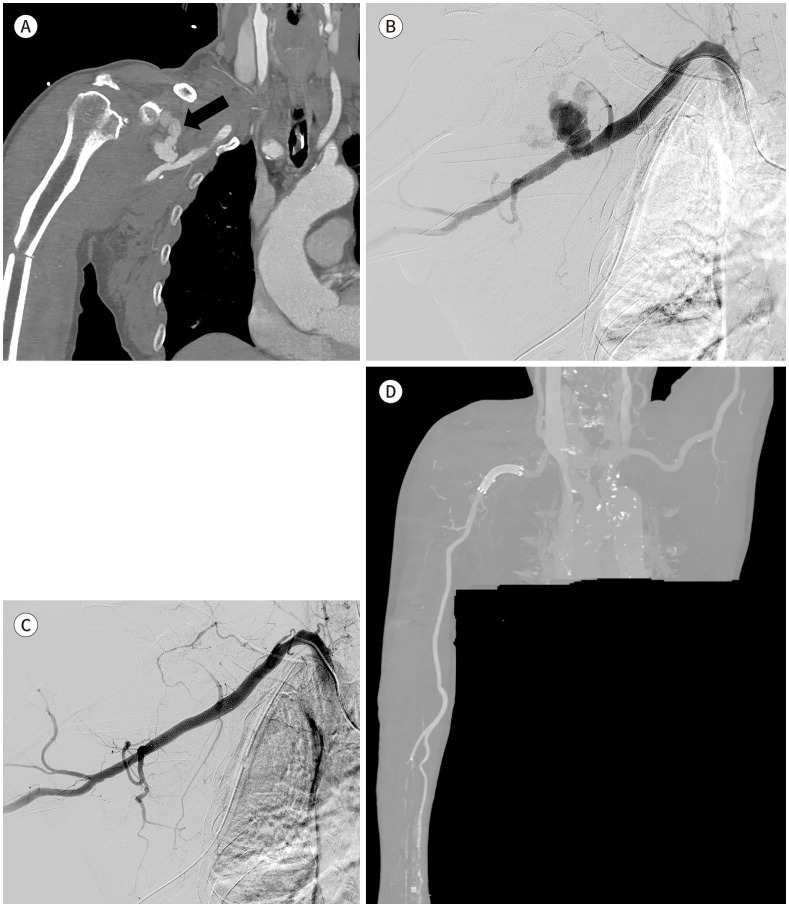 [Endovascular Treatment for Vascular Injuries of the Extremities].