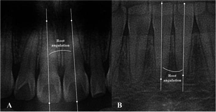 The incidence and severity of open gingival embrasures in adults treated with clear aligners and fixed appliances: a retrospective cohort study.