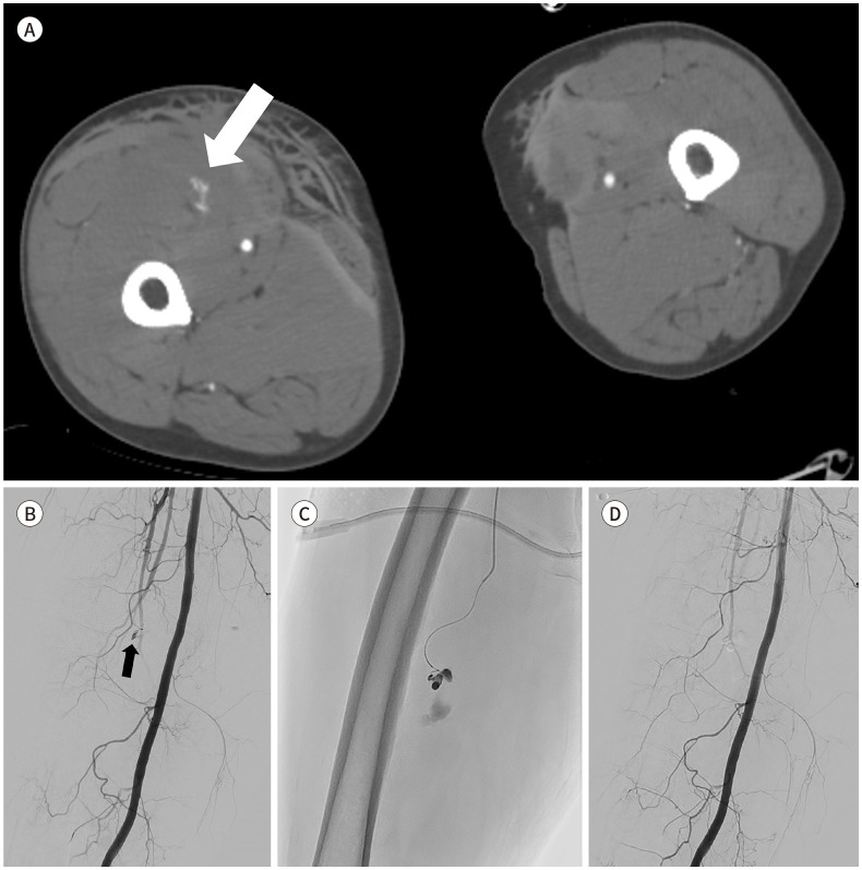 [Endovascular Treatment for Vascular Injuries of the Extremities].