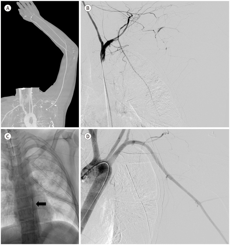 [Endovascular Treatment for Vascular Injuries of the Extremities].