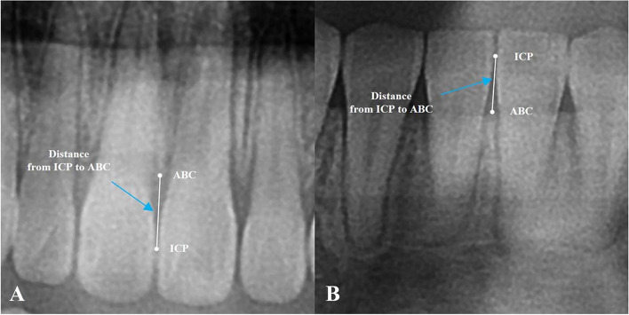 The incidence and severity of open gingival embrasures in adults treated with clear aligners and fixed appliances: a retrospective cohort study.