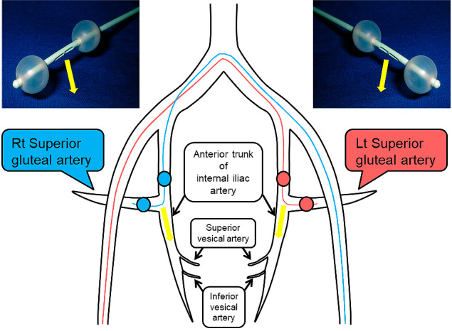 Detection of the Vesical Arteries Using Three-dimensional Digital Subtraction Angiography Relevant to Intra-arterial Infusion Chemotherapy for Bladder Cancer Using Double-balloon Catheters.