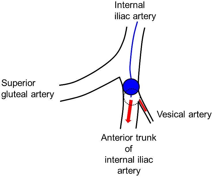 Detection of the Vesical Arteries Using Three-dimensional Digital Subtraction Angiography Relevant to Intra-arterial Infusion Chemotherapy for Bladder Cancer Using Double-balloon Catheters.