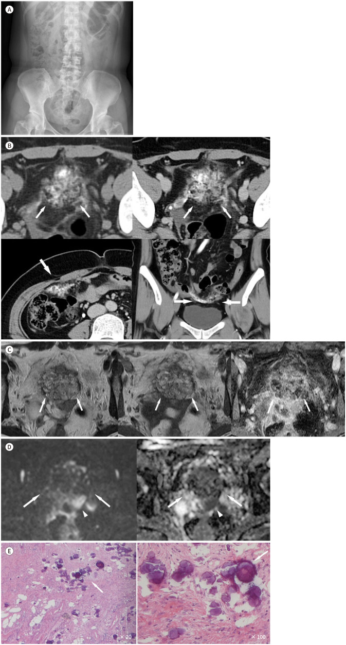 Primary Peritoneal Psammocarcinoma Misdiagnosed as an Heterotopic Ossification: A Case Report.