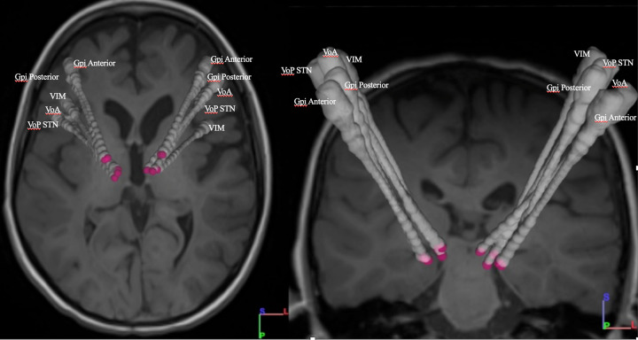 Deep brain stimulation in an adolescent with hypomyelination with atrophy of the basal ganglia and cerebellum due to a TUBB4A mutation: illustrative case.