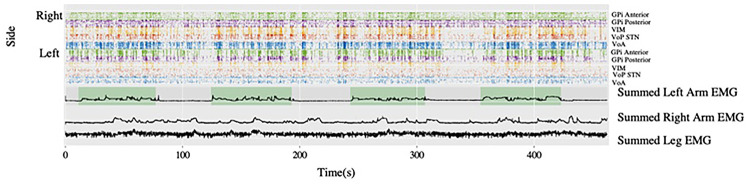 Deep brain stimulation in an adolescent with hypomyelination with atrophy of the basal ganglia and cerebellum due to a TUBB4A mutation: illustrative case.
