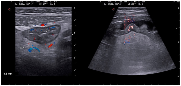 Severe Typhoid Fever Complicated by Superior Mesenteric and Splenic Vein Thrombosis.