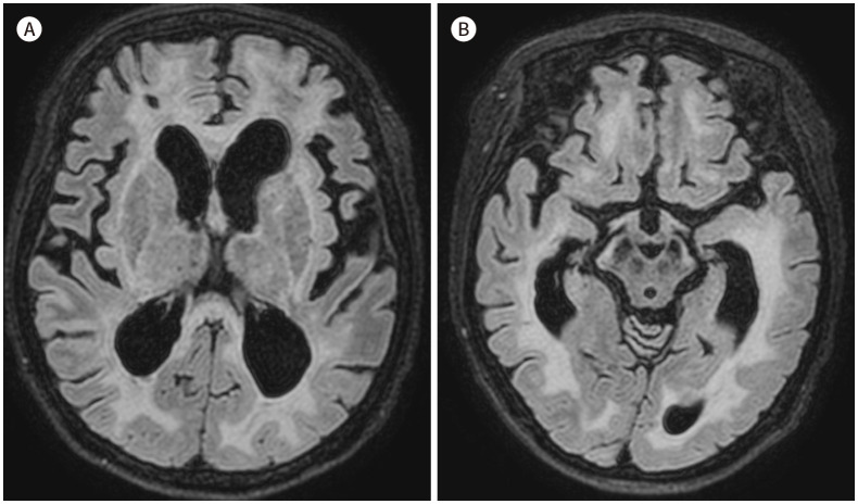 [Neuroimaging Characteristics of Cerebral Autosomal Dominant Arteriopathy with Subcortical Infarcts and Leukoencephalopathy (CADASIL) in Korean Based on Jeju Cohort: A Pictorial Essay].