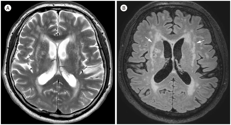 [Neuroimaging Characteristics of Cerebral Autosomal Dominant Arteriopathy with Subcortical Infarcts and Leukoencephalopathy (CADASIL) in Korean Based on Jeju Cohort: A Pictorial Essay].