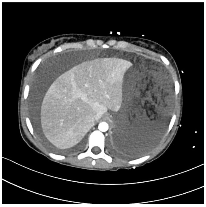 Severe Typhoid Fever Complicated by Superior Mesenteric and Splenic Vein Thrombosis.