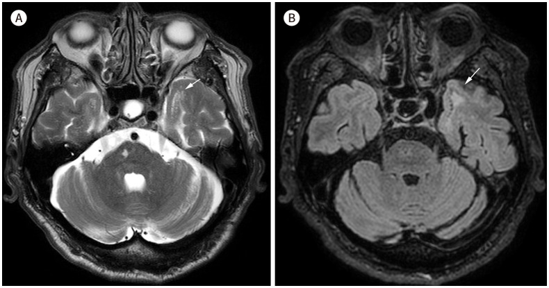 [Neuroimaging Characteristics of Cerebral Autosomal Dominant Arteriopathy with Subcortical Infarcts and Leukoencephalopathy (CADASIL) in Korean Based on Jeju Cohort: A Pictorial Essay].