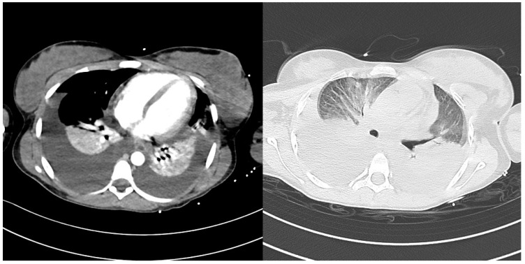 Severe Typhoid Fever Complicated by Superior Mesenteric and Splenic Vein Thrombosis.