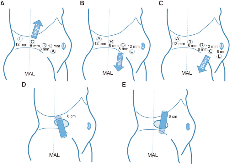 Retroperitoneal robot-assisted laparoscopic nephroureterectomy using the da Vinci Xi and SP systems: Initial experiences in cadaveric models.