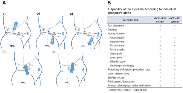 Retroperitoneal robot-assisted laparoscopic nephroureterectomy using the da Vinci Xi and SP systems: Initial experiences in cadaveric models.