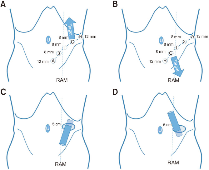 Retroperitoneal robot-assisted laparoscopic nephroureterectomy using the da Vinci Xi and SP systems: Initial experiences in cadaveric models.