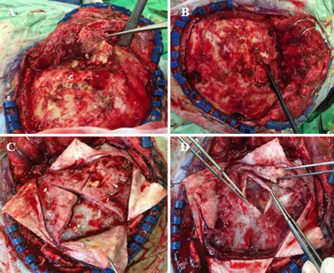 Pachymeningeal en plaque metastasis from gastric cancer mimicking subdural hematoma: illustrative case.