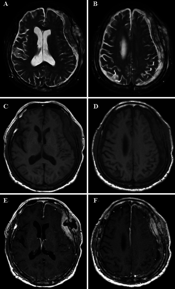 Pachymeningeal en plaque metastasis from gastric cancer mimicking subdural hematoma: illustrative case.