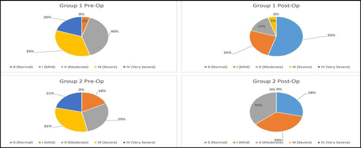 Effectiveness of Uvulopalatoplasty and Nasal Surgery in OSAS Patients.