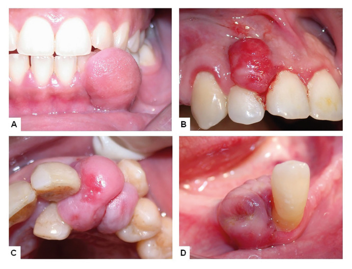 Gingival and alveolar mucosal reactive hyperplastic lesions: a retrospective clinical and histological study of 996 cases.