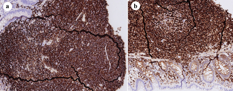 Mucosa-Associated Lymphoid Tissue Lymphoma of the Ascending Colon Successfully Removed With Endoscopic Submucosal Dissection.