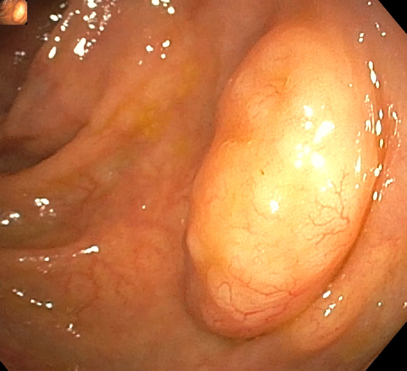 Mucosa-Associated Lymphoid Tissue Lymphoma of the Ascending Colon Successfully Removed With Endoscopic Submucosal Dissection.